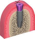 5.6 Weichgewebekonditionierung Verschliessen Sie das Implantat zum Schutz nach der Implantation handfest mit einer Verschlussschraube oder einem Gingivaformer.