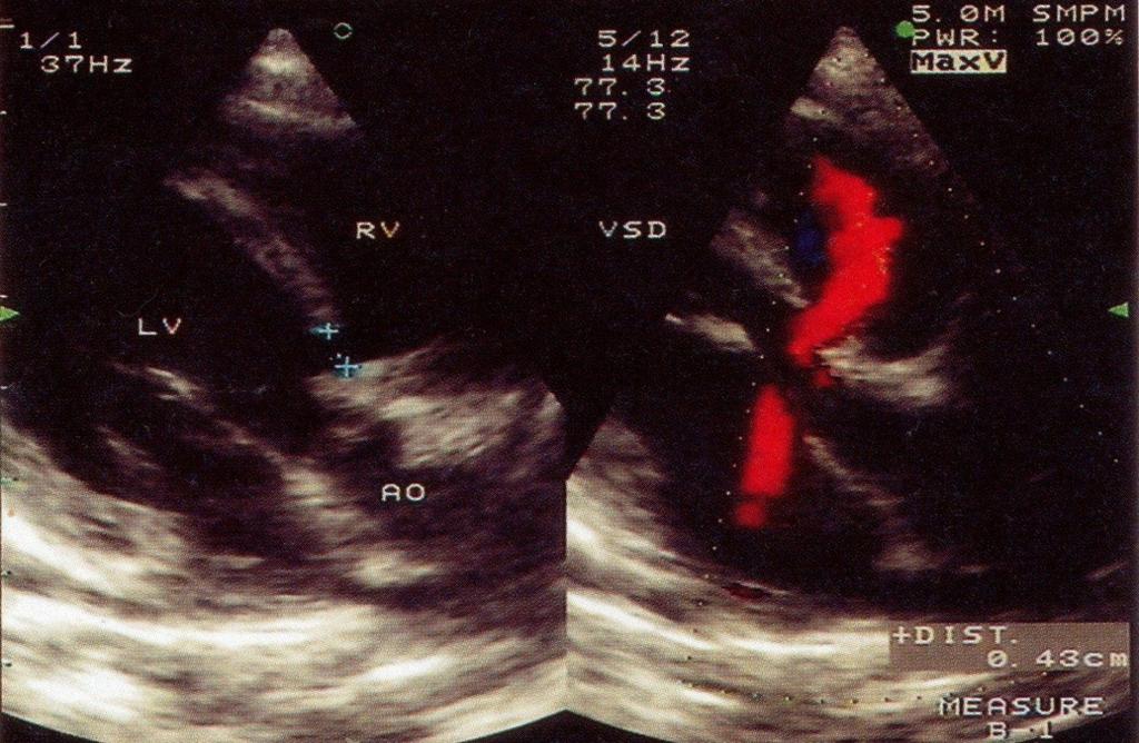 Abbildung 8: Echokardiogramm: perimembranöser VSD mit farbkodiertem Fluss vom linken (LV) in den rechten (RV) Ventrikel. der Defekt misst in dieser Ebene ca. 4,