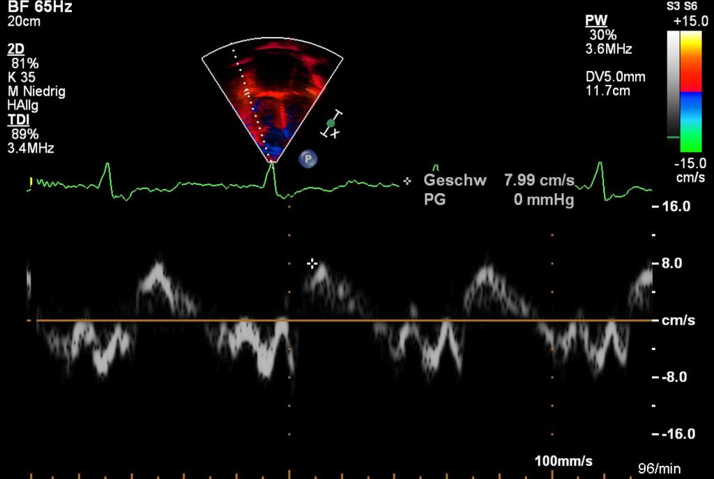 Abbildung 18: Gewebedopplerechokardiographie im apikalen 4-Kammer Blick: Die Abbildung zeigt eine repräsentative TAPSV-Messung bei einem 15-jährigen Jugendlichen mit kongenitaler pulmonaler