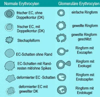 Glomeruläre Erythrocyten Erythrocyten welche über Glomerulum in Urin gelangen sind deformiert dysmorphe Erythrocyten (= glomeruläre EC) sehr unterschiedliche Angaben in Literatur ab wann pathologisch