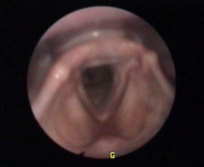 Endoskopische Untersuchungspositionen 1 Übersichtseinstellung ( Home position ) - Valleculae - Sinus