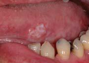 Die Abbildungen zeigen krankhafte Veränderungen am linken Zungenrand respektive auf dem Mundboden.