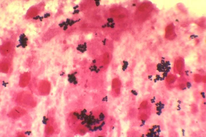 S. aureus Kolonisation/Infektion von CF Patienten während einer 6-jährigen prospektiven Studie Gramfärbung eines Sputums eines CF Patienten -72 Patienten analysiert, Medianes Alter 9.