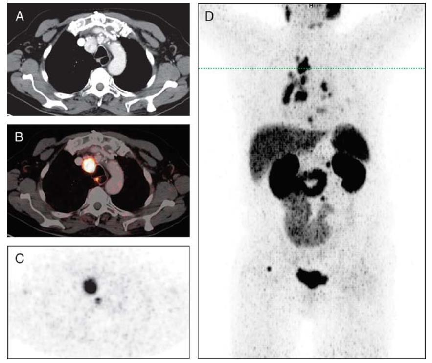 PSMA Expression in Metastatic Differentiated Thyroid Cancer 68 Ga-PSMA PET/CT Iodine-negative / FDGpositive