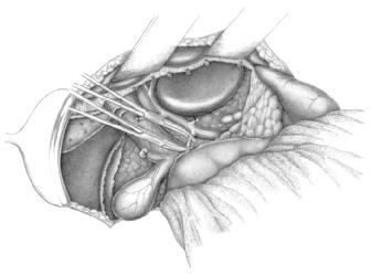 Durch vorsichtigen Zug des Assistenten nach ventral kann das Duodenum und der Pankreaskopf vom Retroperitoneum abgehoben werden.