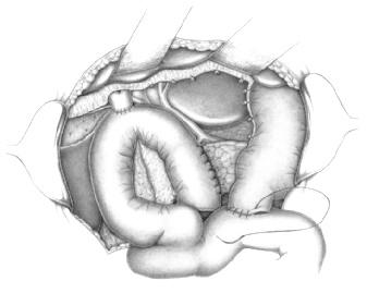 65. Pyloruserhaltende Pankreaskopfresektion (Whipple, Traverso-Longmire) Bauchhöhle: Pankreas 259 8 Duodenojejunostomie Abgeschlossen wird der Eingriff mit dem Wiederanschluss des Magens.