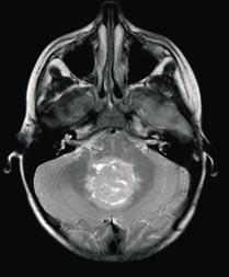 16 Abbildung: Medulloblastom bei einem fünfjährigen Kind: Tumor in der Mitte mit weißlichen zystischen Anteilen, MRT-Bild (T2-Wichtung) Quelle: Prof.