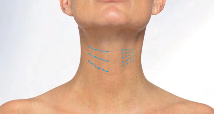 Coy So wird behandelt Die Falten oder Hautbezirke können je nach Befund entweder durch eine linien- oder unktförmige Untersritzung behandelt werden.