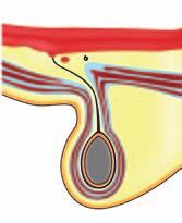 Was ist eine Inguinalhernie* 1 und bei wem tritt sie auf? Eine Hernie ist die Hervorwölbung eines Organs oder von Gewebe durch eine krankhafte Öffnung im Körper.