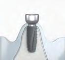 This is isy Einfachheit 11 Abformung mit Multifunktionskappe offene Einheilung Gingivaformer auf Implantatbasis Abformung auf Implantatbasis Scan der Multifunktionskappe Finale Versorgung auf