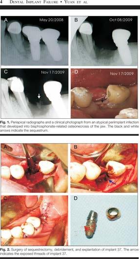Orale Bisphosphonate & Implantate Fazit: Orale Bisphosphonate, Implantatchirurgie und Langzeiterfolg Orale Bisphosphonate (v.a. bei Osteoporose)