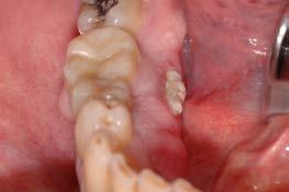 das Parodont mit der Mundhöhle kommuniziert Traumata (Extraktionen, Osteotomien, etc.