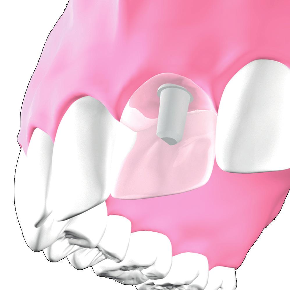 Geeignet zur Einzelzahnversorgung Passt in lückenhaften Zahnreihen Es gibt viele Gründe für den Verlust eines