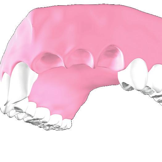 Die künstliche Zahnwurzel (Implantat) wird in den Kieferknochen eingebracht.