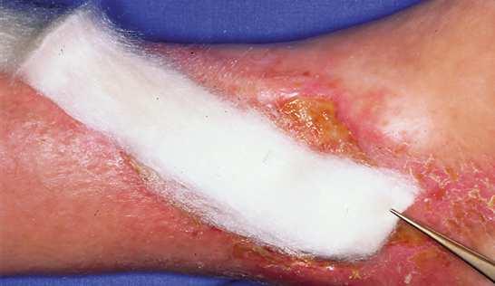 Alginate Anwendung lockere Tamponade (ca. 2/3 der Wunde) bei schwacher Sekretion anfeuchten keine Überlappung des Wundrandes (Hautmazeration!