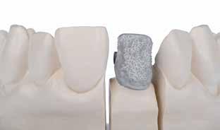 Opaker Das Abdecken der Gerüste in der gewünschten Zahnfarbe erfolgt mit dem lichthärtenden Universal-Opaque-System, welches bereits bei den Pastensystemen Ceramage und Solidex Anwendung findet.