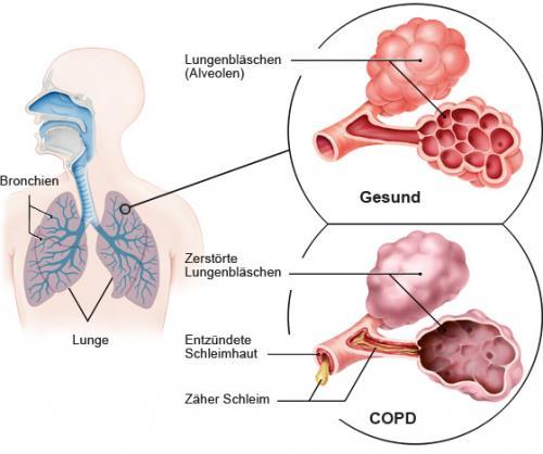 INFOBOX 3: Chronische obstruktive Lungenkrankheit (COPD) Bei der COPD kommt es zu einer chronischen Entzündung in den Bronchien.