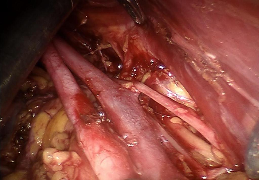 4. Iliaca Communis Lymph Basin (ci, lateral) Aortenbifurkation bis Communisbifurkation