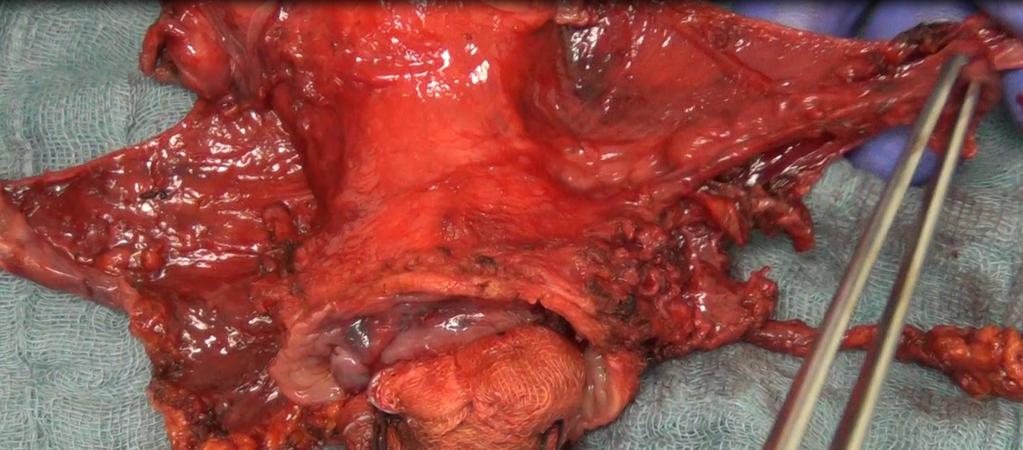 1. Mesometriales Kompartiment Komplette Resektion des Uterus, der Tuben,