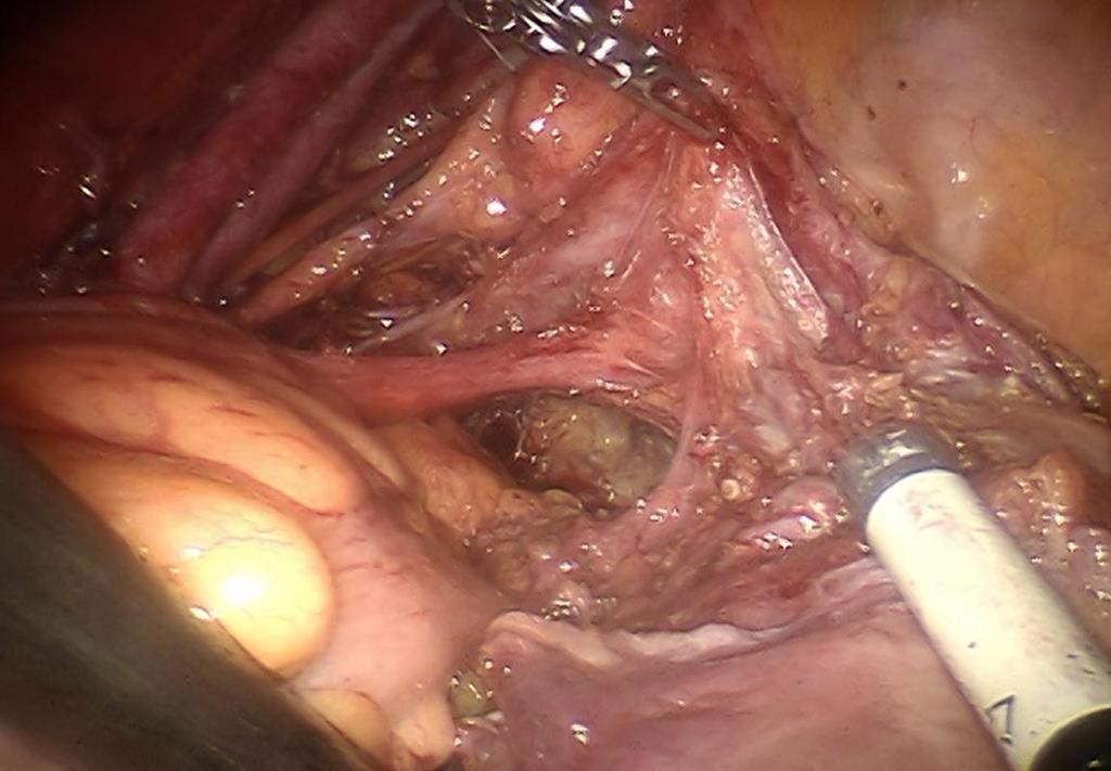 1a. Vaskuläres Mesometrium (mm) ventral
