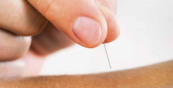 10 Akupunktur Die Behandlung mit Akupunkturnadeln ist die im Westen wohl bekannteste Methode der chinesischen Medizin.
