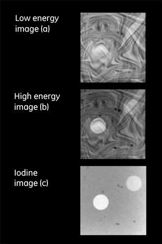 kontrastverstärkte Spektralmammografie Beispiel: Kontrastmittel Injektion (venös) 1 Aufnahme mit niedriger Spannung (üblicher kv Bereich Mammografie) 1 Aufnahme mit höherer Spannung und höherer