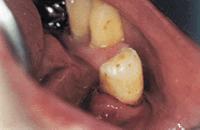 Zahnhalskaries Fertige Zahnhalsfüllung (Fotos: Archiv) Auch bei den sogenannten keilförmigen Defekten - das sind Kerben oder Mulden im Zahnhalsbereich, unmittelbar über dem Zahnfleisch, die recht