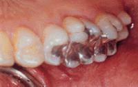Schon über 170 - ZahnRat 19 - Landeszahnärztekammer Brandenburg gesundheitsschädigende Wirkung der Zahnfüllung.