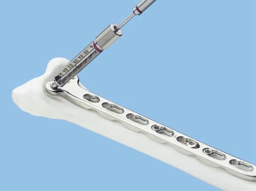 Distale Schrauben einbringen 6 Distale Schrauben einbringen und Gelenkrekonstruktion bestätigen Instrumente 310.509 Spiralbohrer B 1.
