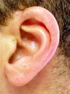 Visuelle Diagnostik des Ohres 3.1 Anatomie und Strukturbereiche des äußeren Ohres Die Ohrmuschel ist der von vorn sichtbare Teil des Ohres.
