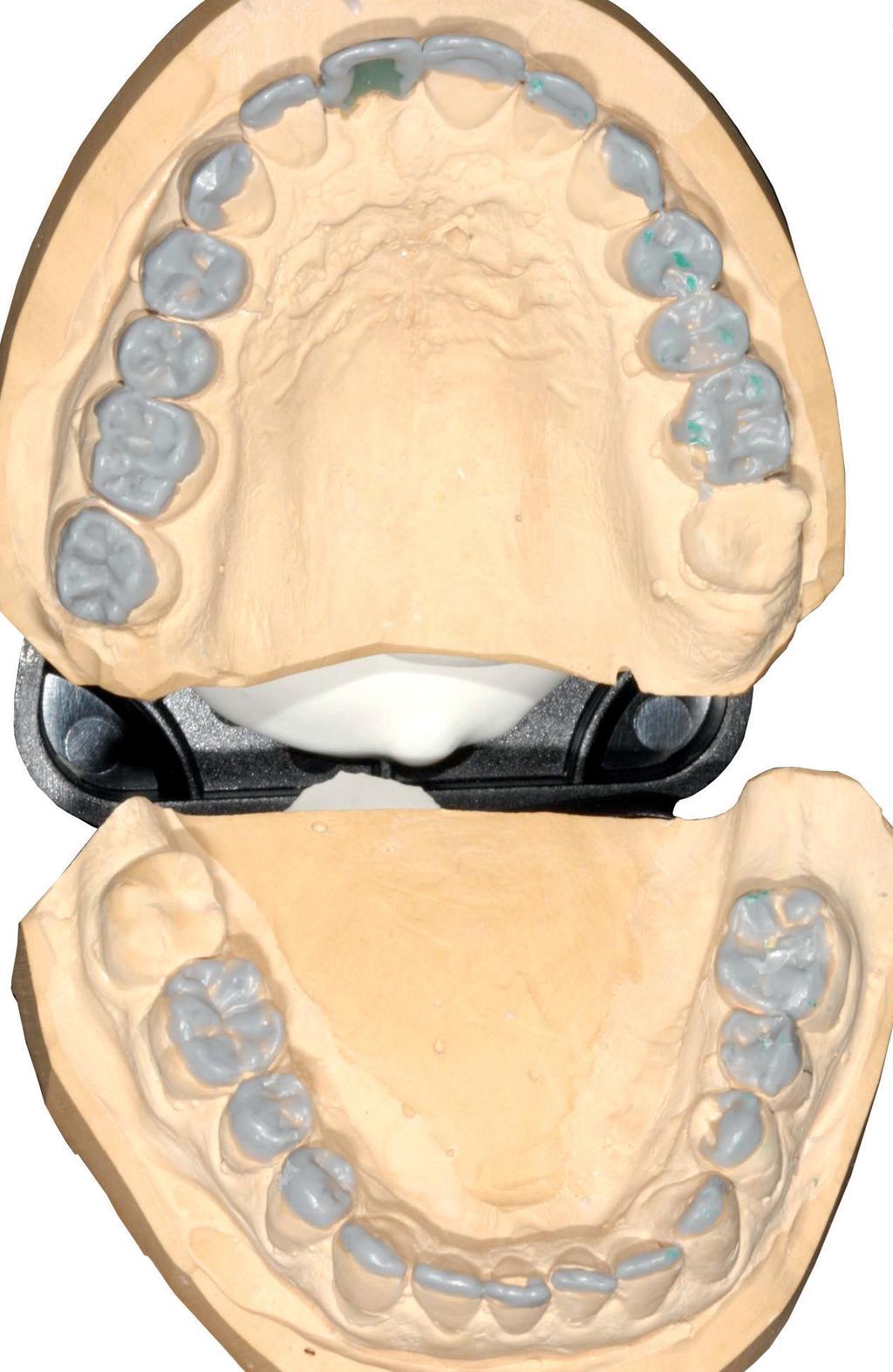 Mit einem entsprechenden Mock-up am Patienten konnte so demonstriert werden, wie sich ästhetische Parameter wie Zahnlänge, Gesichtsprofil und -physiognomie verändern.