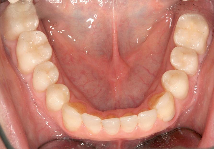 Insbesondere das veränderte Lippenbild mit Verlängerung der Frontzähne und dem gewünschten Schluss des Diastemas wurde im Umfeld des Patienten durchweg positiv beurteilt.