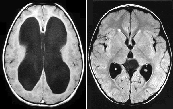 Hirndruck durch Liquor Hydrozephalus (z.b.