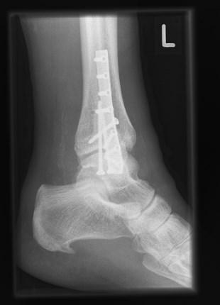 Tibia nach operativ behandelten Syndesmosenverletzungen ist, aus den bereits genannten Gründen, durch konventionelle Röntgenaufnahmen nicht mit ausreichender Zuverlässigkeit möglich.