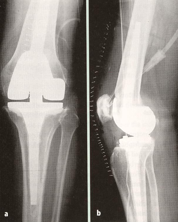 Endoprothetik des Kniegelenkes Gekoppelte Totalendoprothesen (Bi- und trikompartimentaler Ersatz) Scharniersystem Rotationssystem