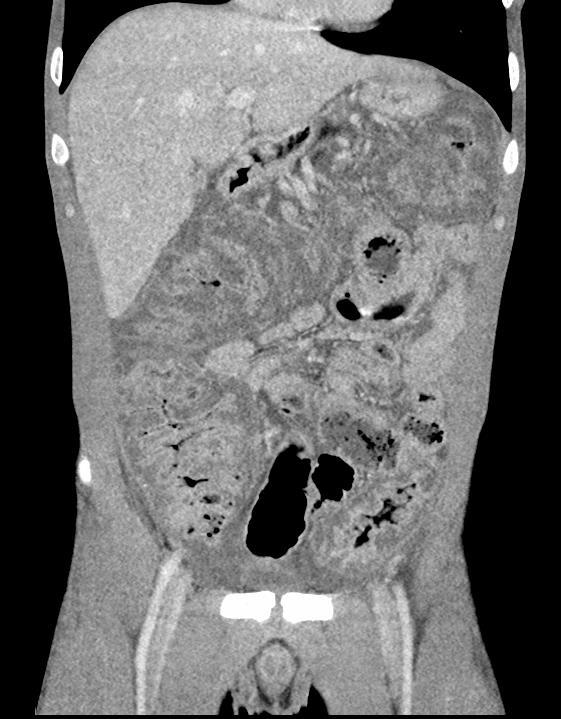 FMT bei schwerer CDI 21j Mann mit Zystischer Fibrose und CDI nach Antibiotikatherapie