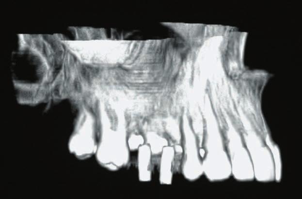 9 Der mit der Diagnostikschablone im Mund durchgeführte CT-Scan bestätigte den Knochendefekt zwischen der Idealposition der prothetischen