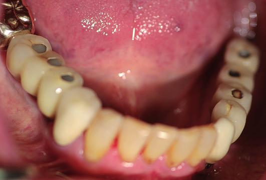 Fallbeispiel 3 Eine Patientin, zum Implantationszeitpunkt Mitte 50, litt sehr unter der bereits mit 46 Jahren einge tre tenen Zahnlosigkeit im Oberkiefer.