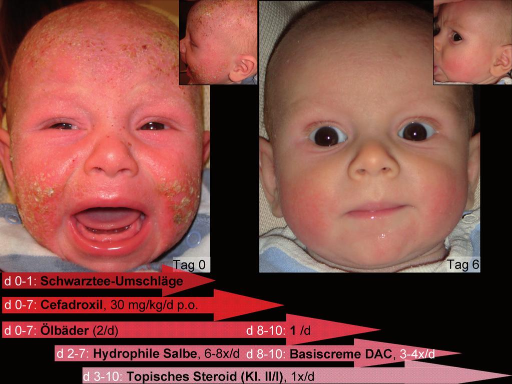 Lau und Höger 64 Abb. 2. Verlauf unter kombinierter Basis-, antiinflammatorischer und antimikrobieller Therapie bei einem Säugling mit schwerem atopischem Ekzem.