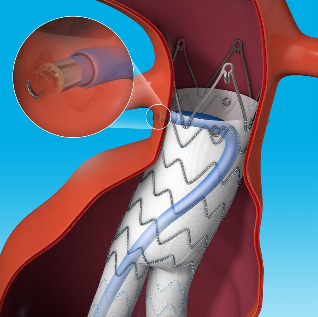 Aneurysma bei endovaskulärer Implantation von mehreren Stent-Prothesen, Aorta abdominalis (Chimney-Technik) Aneurysma bei endovaskulärer Implantation von mehreren Stent-Prothesen, Aorta abdominalis,
