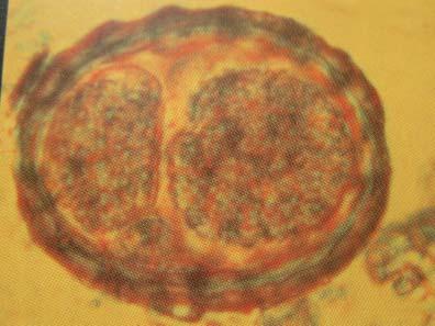 Intestinale Helminthosen a d b e Abb. 11.17a e Spulwurm-(Ascaris)-Eier sehen nach Reifungsgrad verschieden aus.