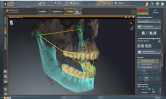 IN NUR 4 SCHRITTEN Digitaler Workflow mit Patientenscan 1 Röntgenscan mit einem Dentsply Sirona