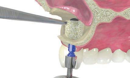 4 Schritt 4 Implantation des maxgraft bonerings Der maxgraft bonering wird durch das laterale Fenster des Alveolarknochens in den für die transalveolare Implantatinsertion vorbereiteten Bereich