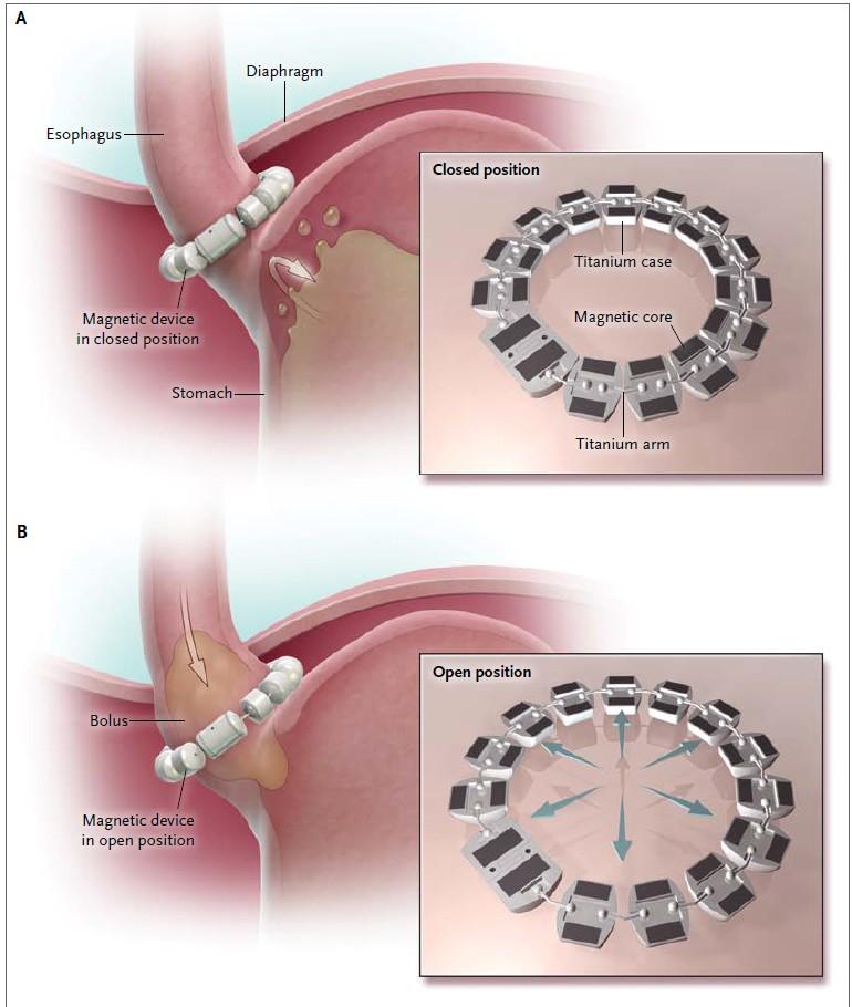 GORD Surgical Treatment Esophageal Sphincter Device (Linx ) für GERD Ganz et al. NEJM 2013;368:719-27 27.