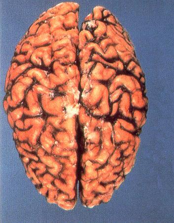 Definition fortschreitende Erkrankung des Gehirns kontinuierliches Absterben von Nervenzellen Störungen des Gedächtnisses, des Denkvermögens, der Sprache, der