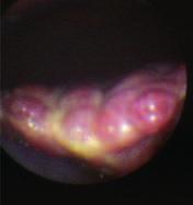 gemischtknotige Form der Leberzirrhose unterschieden (Tab. F-1.30).