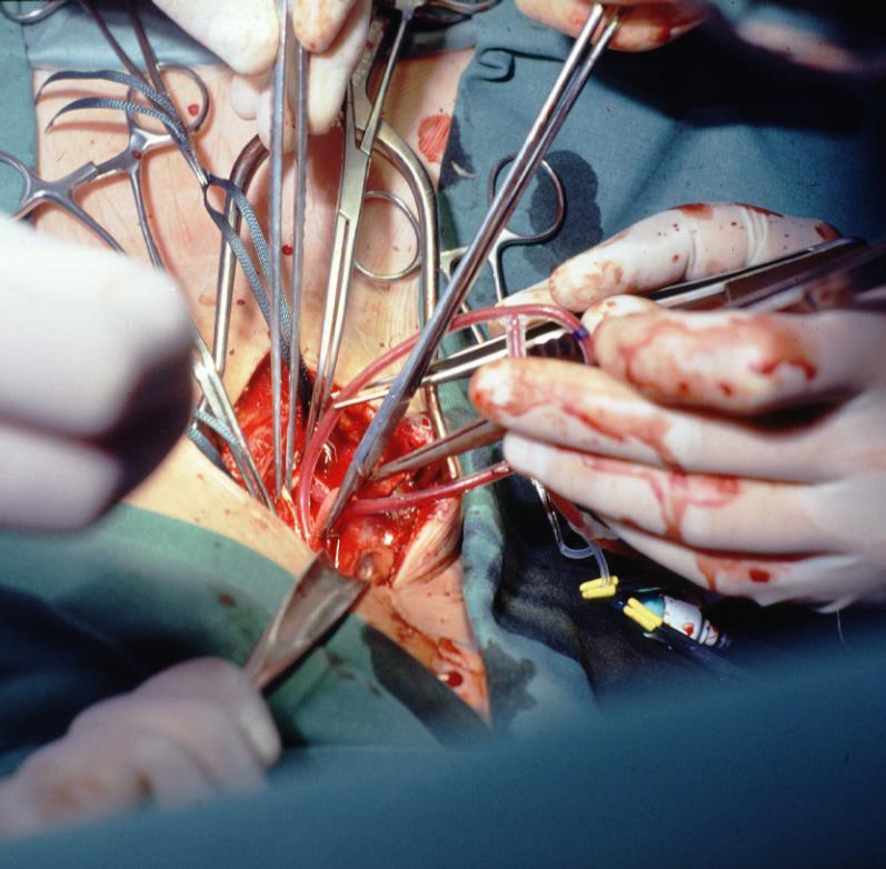 Karotischirurgie: Shuntanlage Shunt wirksamste