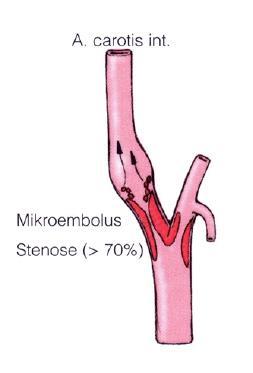 Arteriosklerose/ arteriellen Gefäßeingriffen 2-3% periop.
