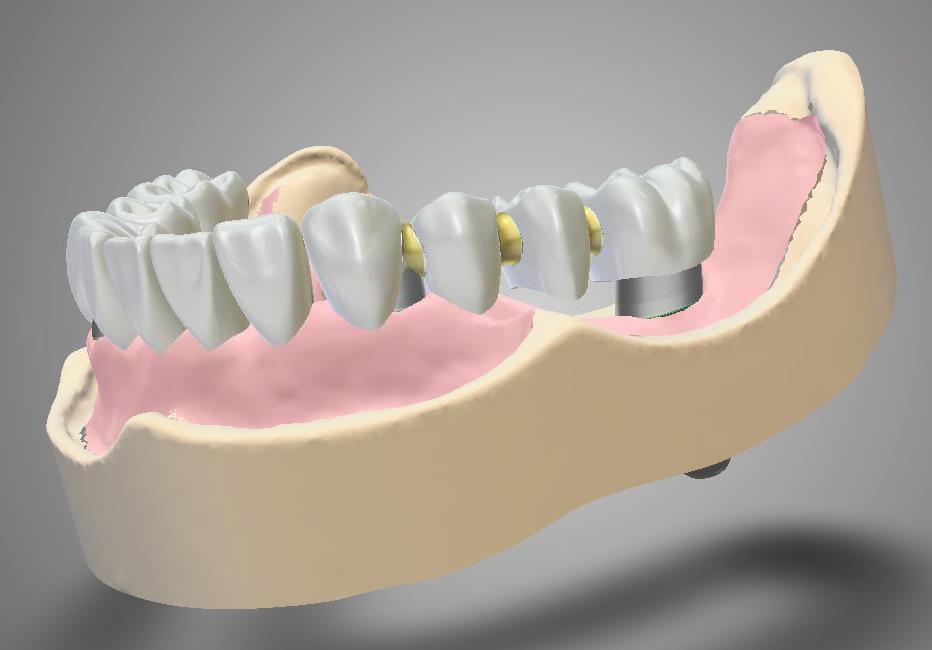 Bei einer gelöschten Gingiva werden automatisch alle