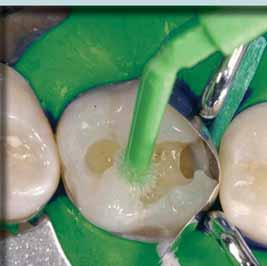 Selbstkonditionierende Bondingsysteme sollen dem Zahnarzt die Arbeitsschritte erleichtern. Herr Dr. Gleixner, welche Probleme können bei der Anwendung der selbstkonditionierenden Adhäsive auftreten?